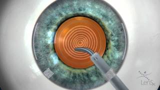 Stephen Slade MD Laser Cataract Surgery Animation [upl. by Inimak554]