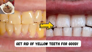 Get Rid Of YELLOW TEETH For GOOD [upl. by Marshall]