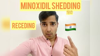 MINOXIDIL SHEDDING मिनोक्सिडिलMinoxidil Finasteride Results Receding Hairline Hairfall Hindi [upl. by Enirak]