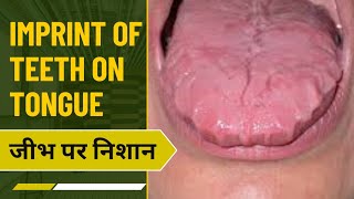 Imprint of teeth on Tongue  scalloped Tongue  जीभ पर दात के निशान  stress  vitamin  smoking [upl. by Noramac]