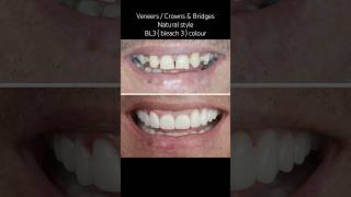 Veneers  Crowns Natural style BL3  OM3  bleach 3  colour dentist smile australia fyp [upl. by Annawot]