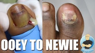 GOOEY FUNGAL TOENAIL REMOVAL TREATMENT CHECK UP [upl. by Teraj]