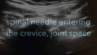 Ultrasound Guided Sacroiliac Joint injection [upl. by Samuela]