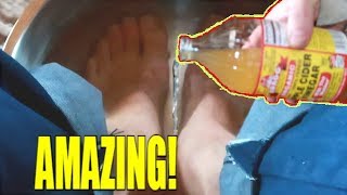 PUT APPLE CIDER VINEGAR ON YOUR FEET AND SEE WHAT HAPPENS [upl. by Eleph767]