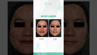 Acne Laser Treatment [upl. by Ericha]