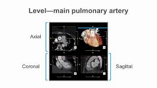 How to identify normal heart structures on a cardiac CT scan [upl. by Chemaram317]