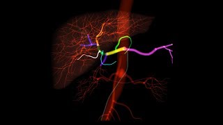 Mentice Transarterial Chemoembolization TACE Training Software [upl. by Abihsot519]