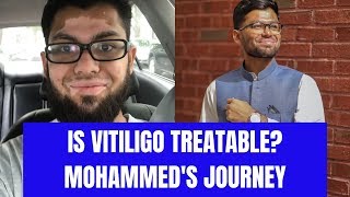 Is Vitiligo Treatable Mohammeds Journey [upl. by Katti]