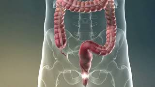 Colonoscopy Procedure in which a doctor uses a colonoscope to examine the large intestine [upl. by Kramal]