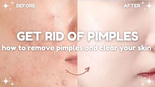 how to get rid of pimples and clear your skin 🧴🫧 acne treatments and dos and donts [upl. by Luhe]