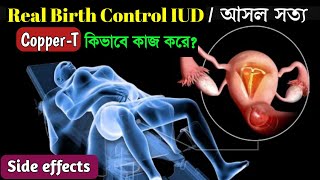 How IUD Works to Prevent Pregnancy Animation। Copper T Insertion and Side Effects । [upl. by Tirrell370]