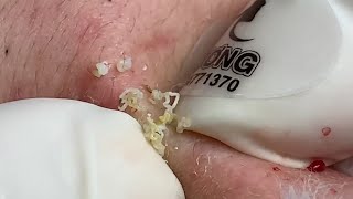 Acne Treatment Huong Da Nang membership 012 part 1   2023 [upl. by Caneghem]