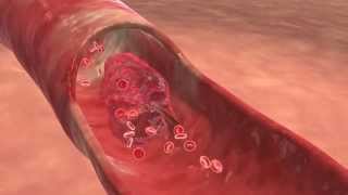 Stent Implant Procedure  Cardiac Animation [upl. by Holna]