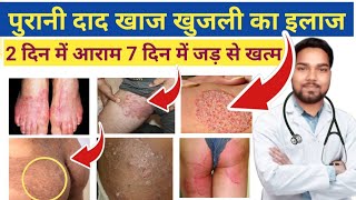 जांघों की दाद खाज खुजली खत्म  Home Remedies For Itching in Private Parts  Fungal infection [upl. by Mintun543]