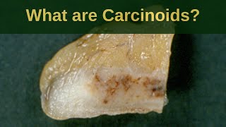 What are Carcinoid Tumours  Pathology mini tutoriaL [upl. by Ahsaeyt]