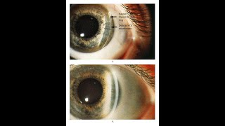 Kayser Fleischer Ring bei Patient mit Morbus Wilson [upl. by Euqnomod999]