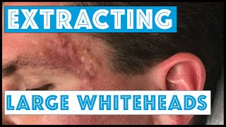 Acne Vulgaris and Extracting large Whiteheads  Part 1 [upl. by Shantee681]