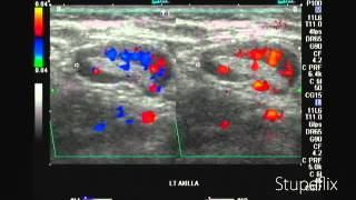 Left axillary lymph node enlargement in breast cancer [upl. by Harat]