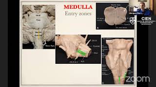 26 Brainstem Cavernomas Concepts Strategies and Technical tips by Dr Jacques Morcos [upl. by Aral]