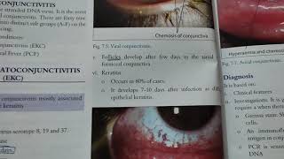 epidemic keratoconjunctivitis opthamology [upl. by Zachery]