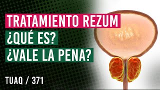 Próstata Lo que necesitas saber sobre el sistema REZUM y sus beneficios [upl. by Aeriela]