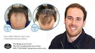 Belgravia Male Hair Loss Treatment Success Story  Tom Full Video [upl. by Etnauq]