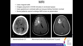 Understanding the Radiology Report to Diagnose Treat and Monitor Brain Tumors [upl. by Keemahs156]