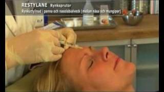 Restylane och Botox behandling [upl. by Aviv]