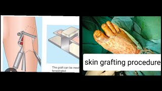 skin grafting in medical surgical nursing  skin graft using fish skin dr youtube doctor [upl. by Ahsieket34]