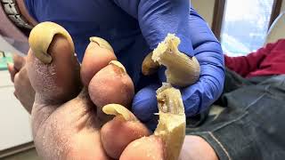 Unbelievable Toenails so long and painful that patient cannot walk [upl. by Beret]