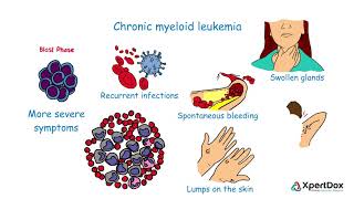 What is Chronic myeloid leukemia [upl. by Irod]