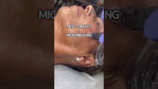 Mesotherapy  Microneedling 50 OFF [upl. by Sander881]