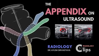 The Appendix on ultrasound and Acute appendicitis  Radiology [upl. by Areik]