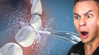 How Cheap Water Flossers Can DAMAGE Your Tonsils [upl. by Blythe]