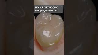 Molar de Zirconio impresión dental odontologia guayaquil ortodoncia sonrisa [upl. by Alphard460]