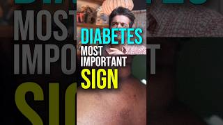 Dark Patches on Skin Discover the Hidden Sign of Diabetes – Acanthosis Nigricans shorts ytshorts [upl. by Irehj273]