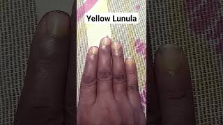 Yellow Lunula Chand 🌒 Sings in Hand Palmistry Dikki astrology palmistry astrology motivation [upl. by Htor900]