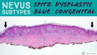 Spitz Nevus Dysplastic Nevus Blue Nevus Congenital Nevus amp more  Dermatopathology Basics [upl. by Rego]