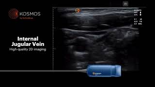 Kosmos by EchoNous for Vascular Access Ultrasound Capabilities [upl. by Ik]