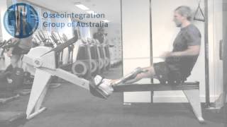 Benefits of Osseointegration  Patient Video [upl. by Haseena996]