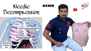 Needle Decompression  tension Pneumothorax clinicaltalks [upl. by Nyliahs]