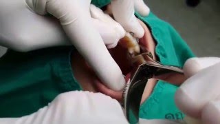 ถอนฟันกรามน้อยซี่ที่หนึ่งเพื่อจัดฟัน 4K First premolar teeth extraction 4K [upl. by Jedlicka]