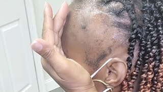 Tutorial  Thin Edges Alopecia CoverUp Using Faux Locs  Ms Pks [upl. by Ennazor]