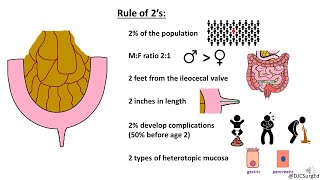 Meckel’s Diverticulum [upl. by Anahsal459]