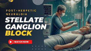 Stellate ganglion block for postherpetic neuralgia [upl. by Windy]