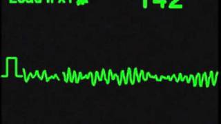 Ventricular Fibrillation  VFIB  ECG Simulator  Arrhythmia Simulator [upl. by Cinom]