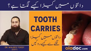 Danton Mein Keera Ka Ilaj  Tooth Cavities Causes amp Treatment  Dant Men Kida Lag Jaye To Kya Karen [upl. by Perkins331]