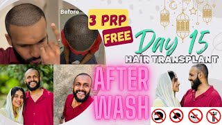 ✨Hair Transplant  Part 3 🤟🏼After Washing💆🏻‍♂️ഇതൊക്കെ ആണ് Washingന് ശേഷം🔻 [upl. by Kussell]