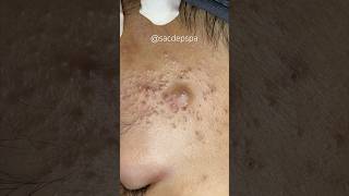 Blackheads blackheads treatments sacdepspa [upl. by Leontine]