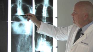 Scoliosis Treatment Options for Children and Adults  El Camino Health [upl. by Pip]